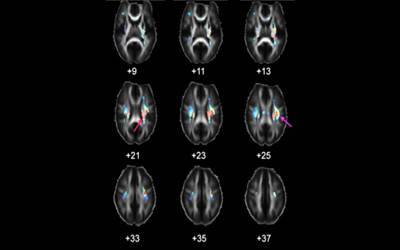 genetic variants20170426174545_l